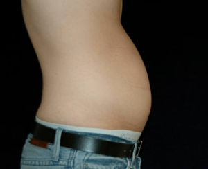 Smartlipo DC