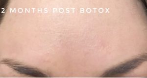 After-botox
