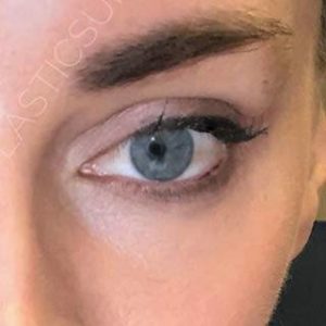 Before and After Fillers Washington DC