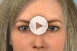 Botox Procedure Information