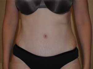 Tummy tuck front after