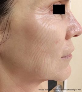 Micro-needling DC