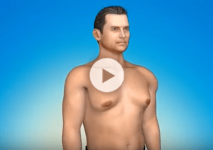 Gynecomastia