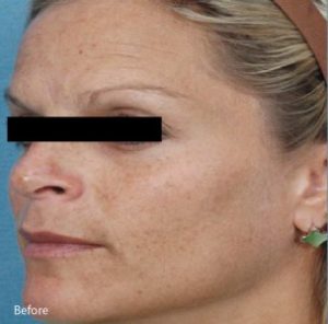 Microneedling DC