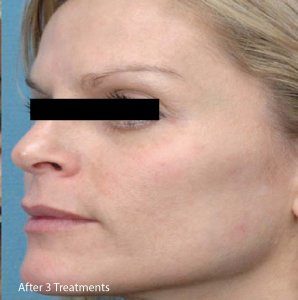 Micro-needling skin results