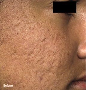 Micro-needling Facial Scars Solution
