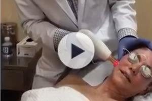 ResurFX Laser Skin Resurfacing