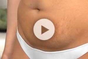 Tummy Tuck Procedure in DC Information