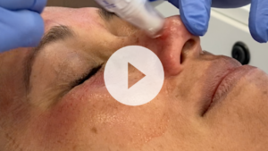 microneedling with PRP washington dc