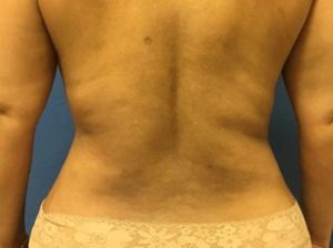 Tummy tuck back after