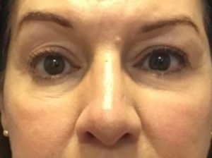 Blepharoplasty after