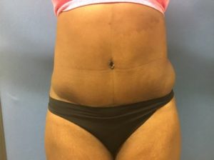 Tummy tuck front after
