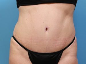 Abdominoplasty after