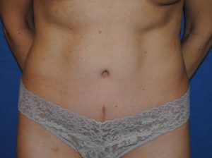 Tummy tuck front after