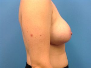 Breast augmentation side after