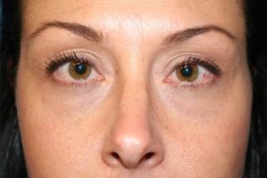 Blepharoplasty after
