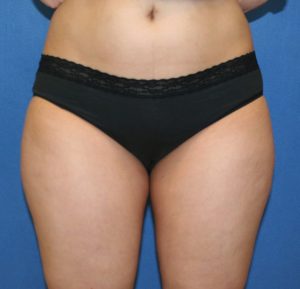 before Smartlipo