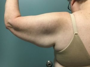 Arm Lift Before (Back of Arm)