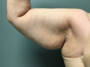 Arm Lift Before (Front Arm)