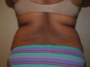Tummy tuck back before