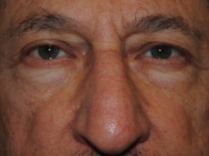 Blepharoplasty before