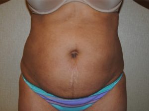 Tummy tuck front before