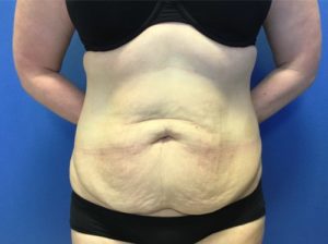 Abdominoplasty Before Front