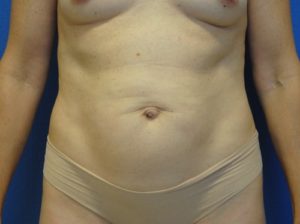 Tummy tuck front before