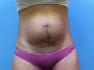 Tummy tuck front before