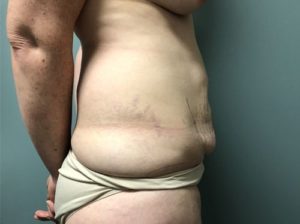 Tummy tuck before (side view)