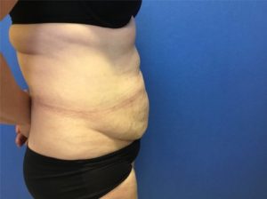 Abdominoplasty Before Side