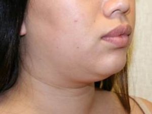 in office liposuction