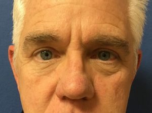 Blepharoplasty after