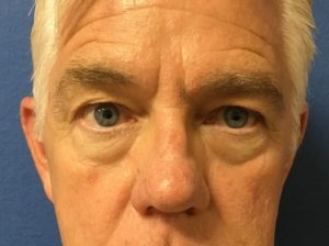 Blepharoplasty before