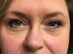 Eyelid Surgery Before