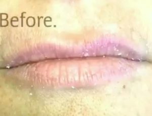 lip-filler-dc-before