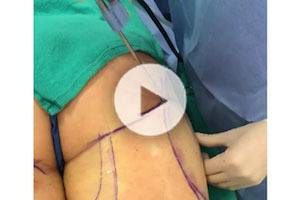 Laser Liposuction
