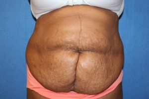 Tummy Tuck Procedure DMV