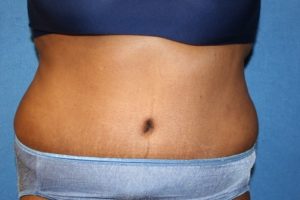 Tummy Tuck Procedure DC