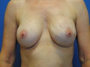 breast reconstruction DC