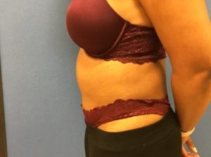 Tummy tuck side after