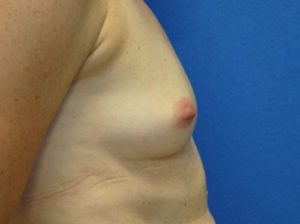 Breast augmentation side before