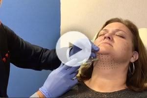 kybella