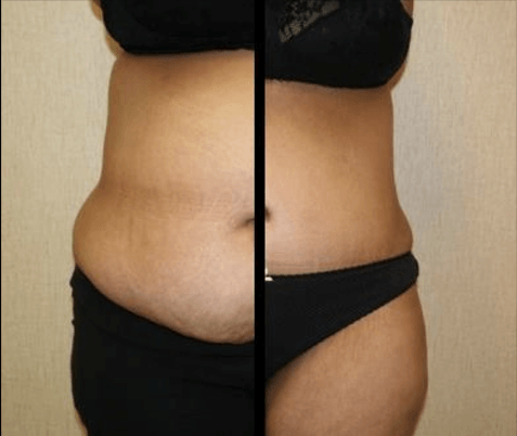 Tummy tuck DC