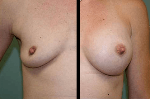 Breast Augmentation DC