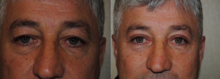 DC Eye Lift Surgery