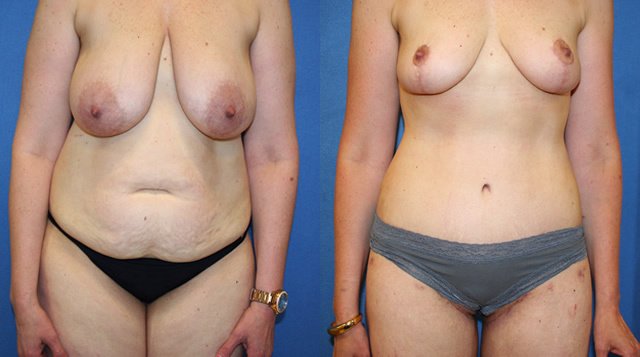The Mommy Makeover