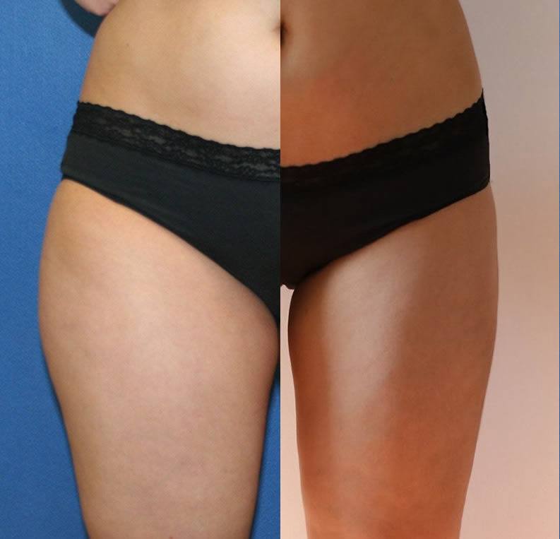 Liposuction DC