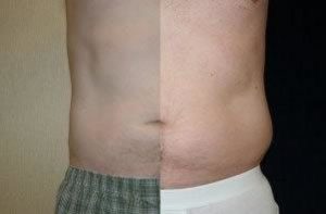 Liposuction Chevy Chase