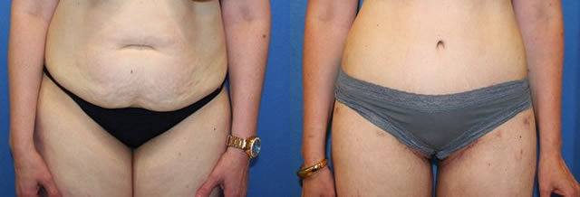 dc liposuction